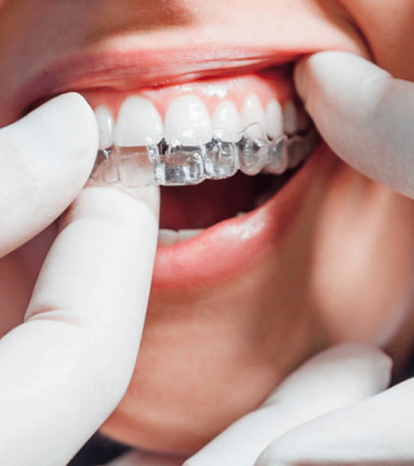 a doctor introduces a invisible aligners for a girl