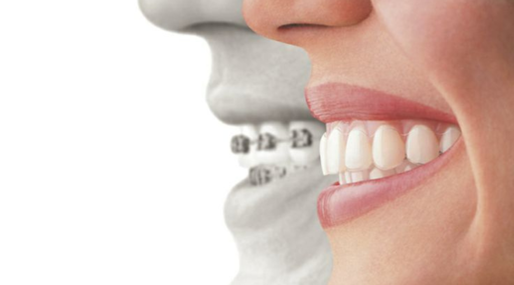 Comparison between metal braces vs Clear aligners