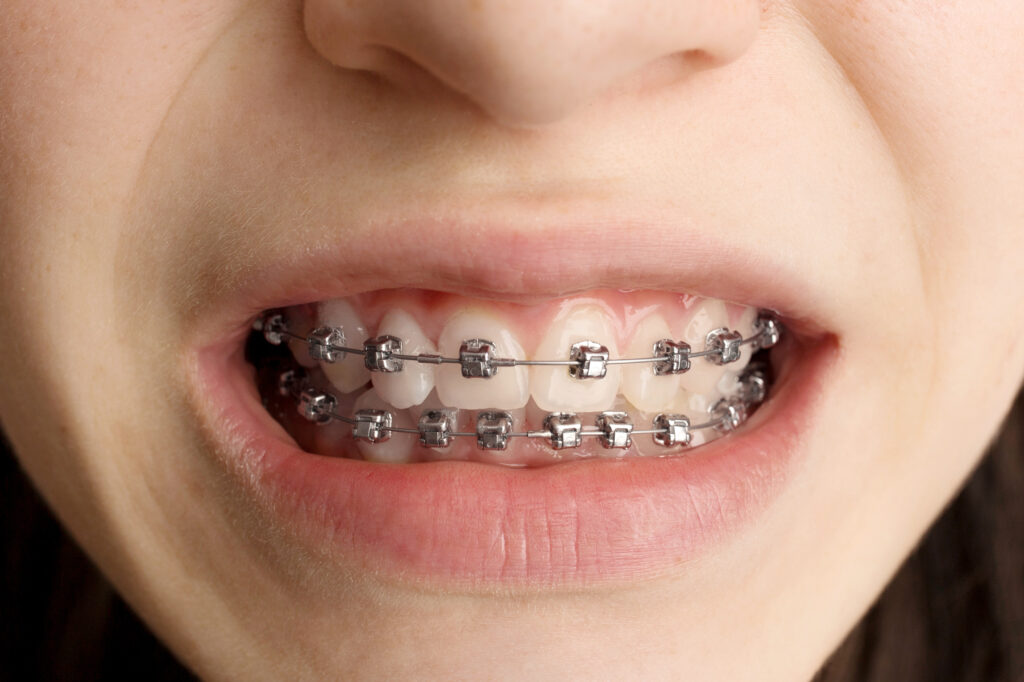 How much will my Invisalign clear aligners cost in Kerala?